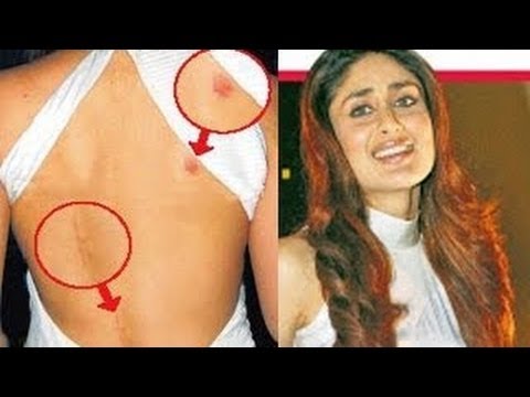 kareena kapoor with hickey on her back